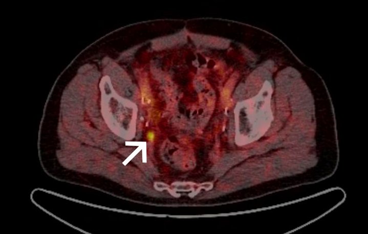 Prostatakrebs: PSMA-PET/CT-Untersuchung einmal monatlich im MVZ Uhlenbrock